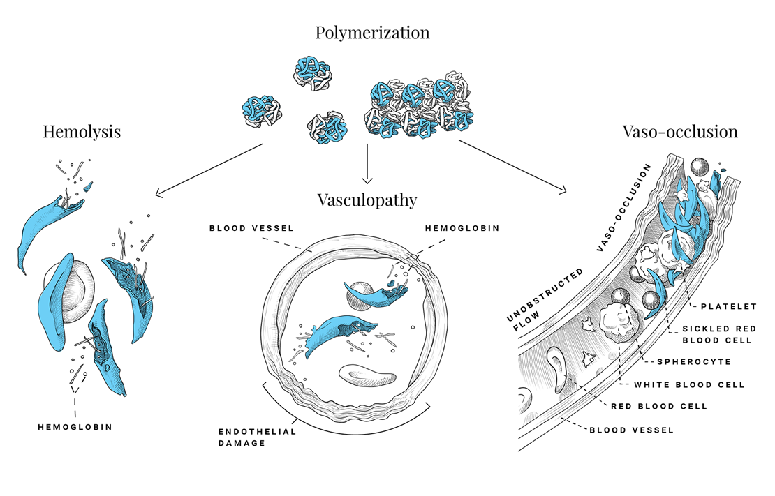 HbS polymerization and vaso-occlusion