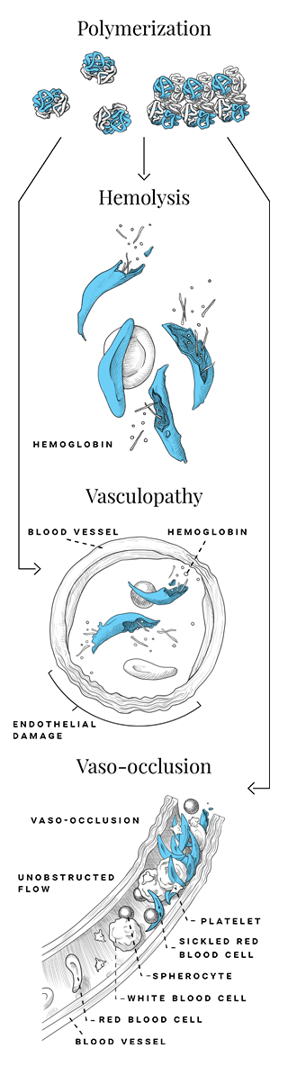 HbS polymerization and vaso-occlusion