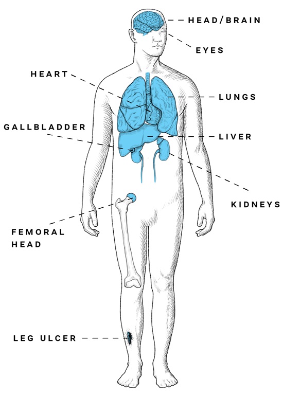 Organs that can be affected by the long-term complications of sickle cell disease