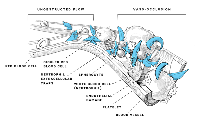 Image showing vaso-occlusion which can lead to vaso-occlusive events